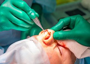 revision-rhinoplasty-sydney