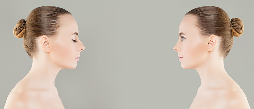 Revision Rhinoplasty Sydney: All you need to know