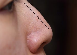 best rhinoplasty-surgeon-sydney