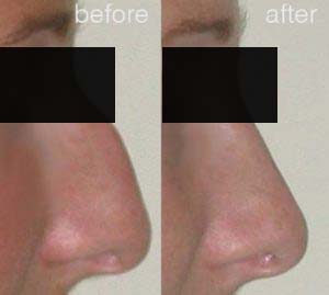 rhinoplasty before after 5