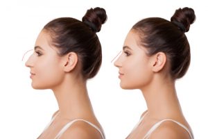 Recovery after Rhinoplasty