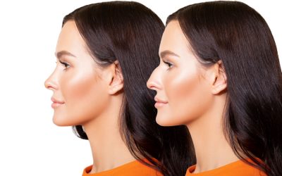 How to Get Rhinoplasty for a Wide Nose: A Comprehensive Guide