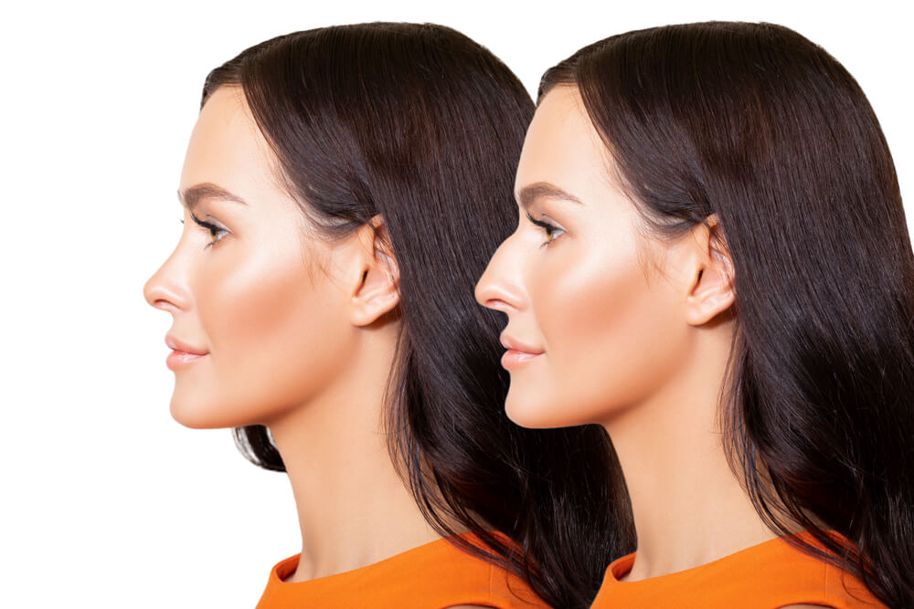 rhinoplasty for wide nose