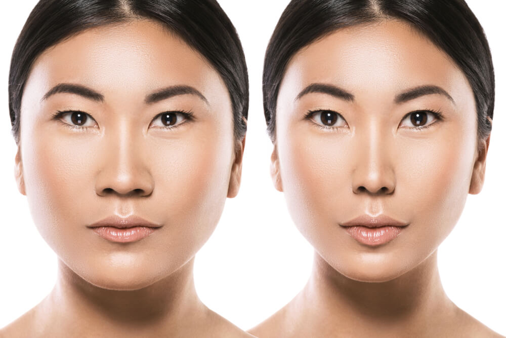 korean nose job before and after