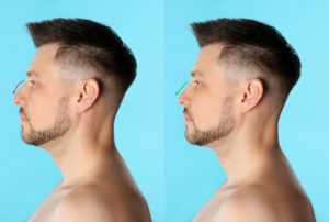 How can Rhinoplasty Masculinize the Nose?