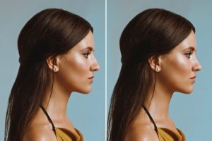 Ultrasonic rhinoplasty vs traditional rhinoplasty