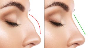 What should I avoid after rhinoplasty?