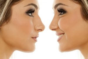 Does private health insurance cover rhinoplasty in Australia?
