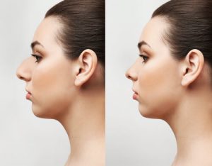 deviated nasal septum treatments before and after